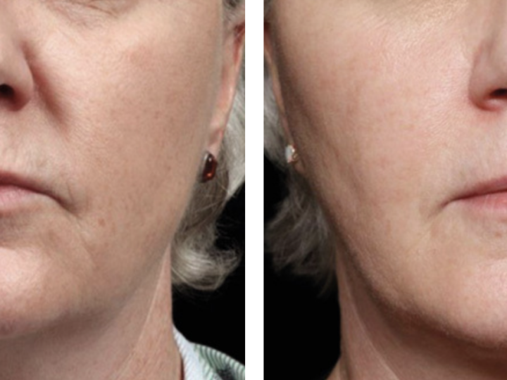 Revolución en el tratamiento de imperfecciones cutáneas