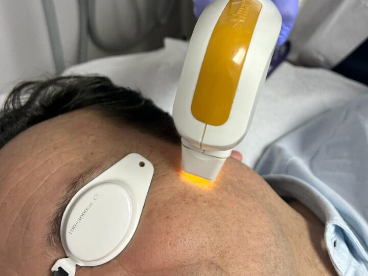 Rejuvenecimiento masculino: láser combinado IPL y Erbio