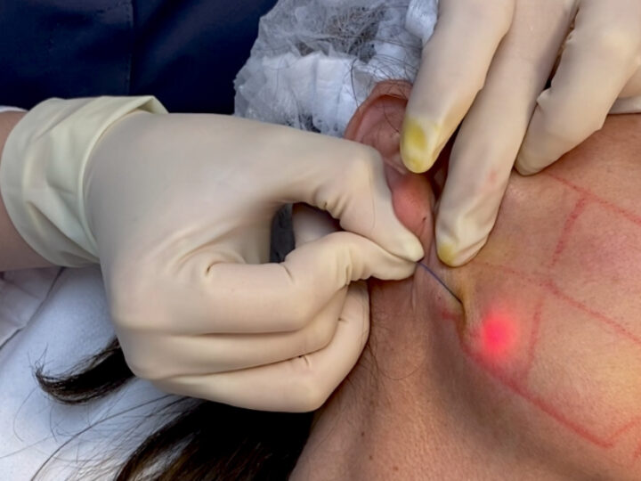 Endolift en Lunik: reafirma y redefine sin cirugía