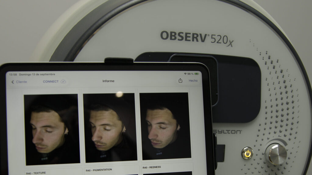 Sistema de análisis de piel OBSERV 520x mostrando imágenes faciales con distintas luces para valorar textura, pigmentación y rojeces